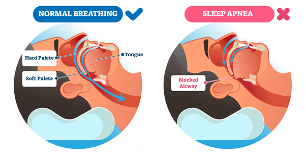 In normal breathing, the airway is open; in Obstructive Sleep Apnea, the airway is blocked by the tongue and soft palate against the back of the throat.