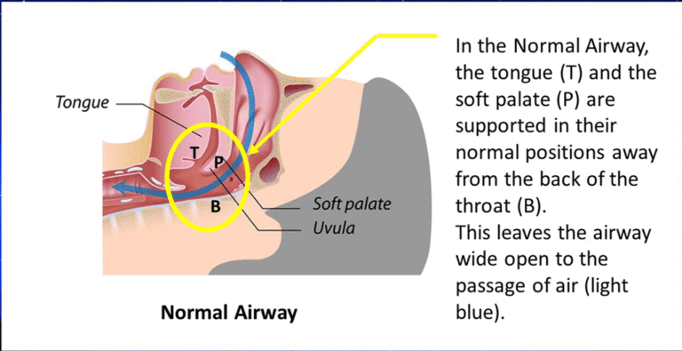 In a Normal Airway, the soft tissues of the throat are open, allowing the patient to inhale and exhale without difficulty.