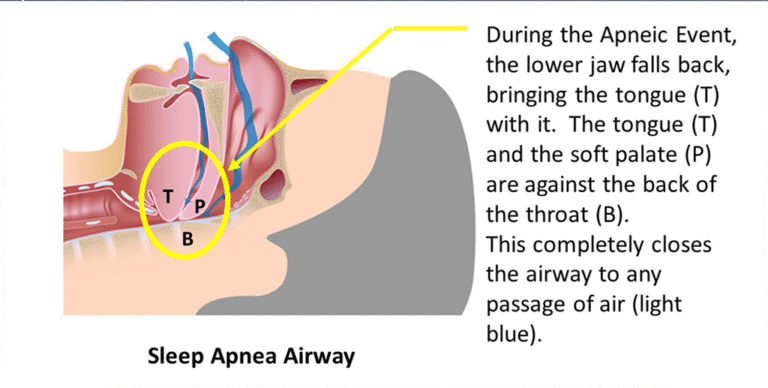 The Alternative to CPAP, Oral Appliance Therapy (Dental Mouthpiece), opens the airway by supportin the lower jaw and tongue. It can fit in the palm of your hand.