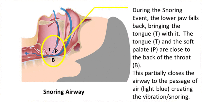 Oral Appliance Therapy (Dental Mouthpiece) opens the airway to stop tissue vibration - the cause of snoring.